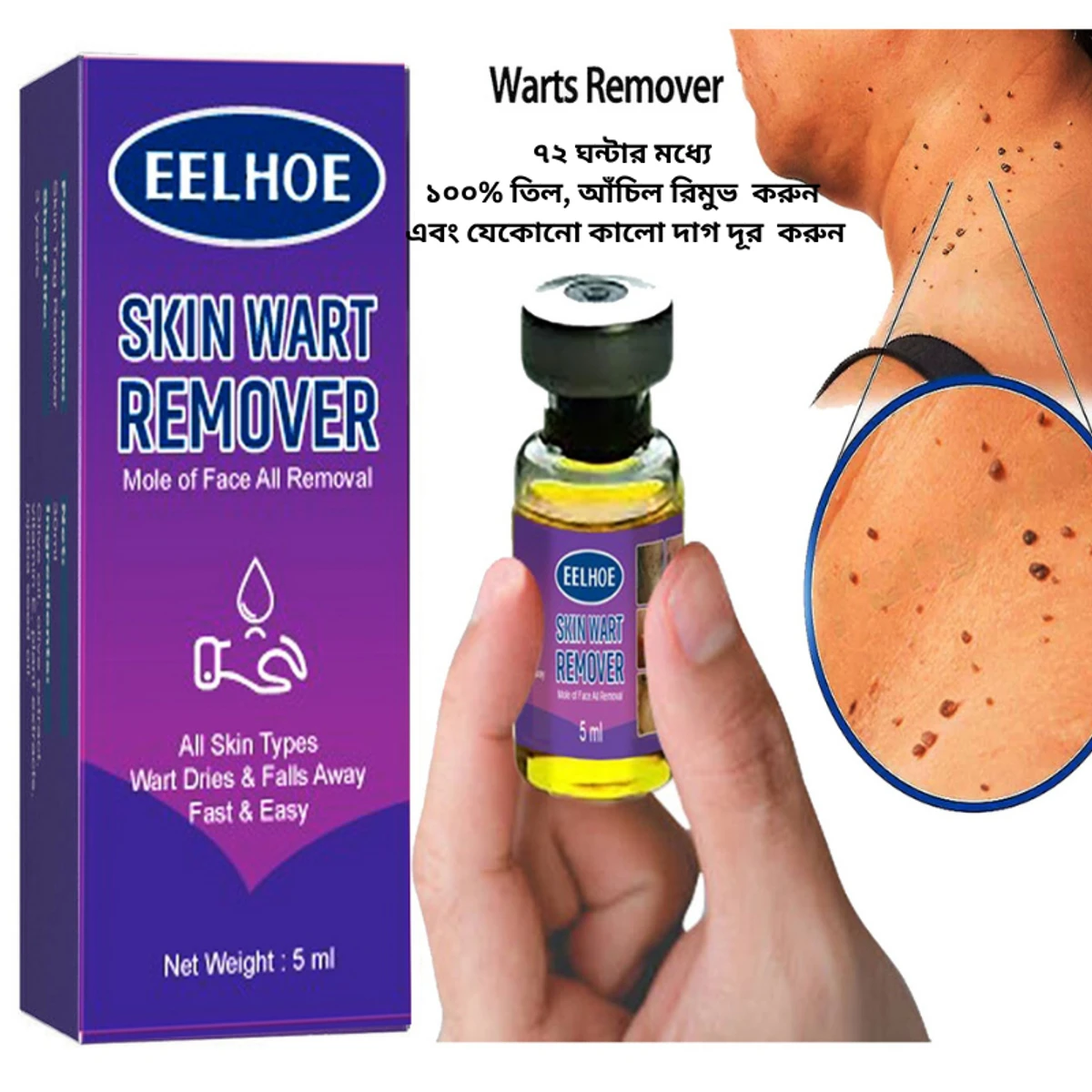 EELHOE SKIN WART REMOVER (৭২ ঘন্টার মধ্যে ১০০% তিল অথবা আঁচিল যাবেই)